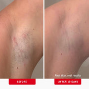 Foliclear Ingrown Hair Pads