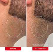 Foliclear Ingrown Hair Pads